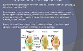 Узнайте причину артроза и исключите ее из Вашей жизни!