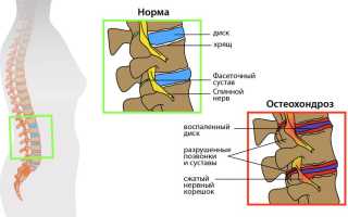 Все нюансы остеоартроза позвоночника от А до Я